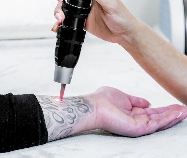 Tattoo Removal Price