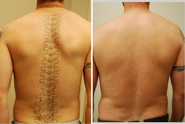 Permanent Tattoo Removal