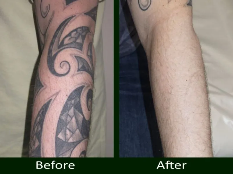 Tattoo Removal