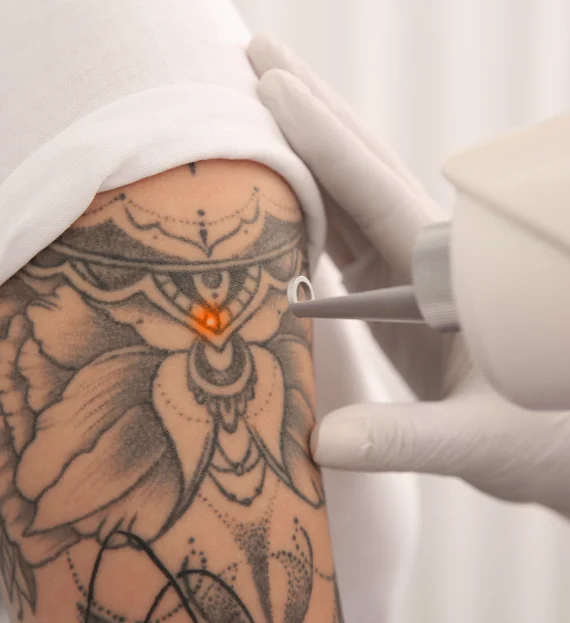 Laser Tattoo Removal