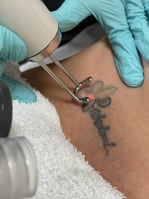 Tattoo Removal