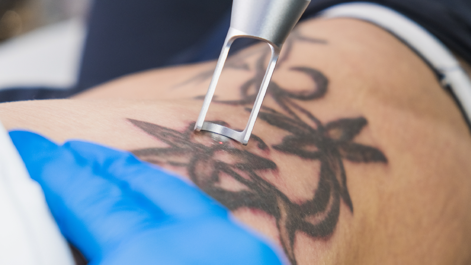 Best Painless Laser and Tattoo Removal in Besant Nagar Chennai