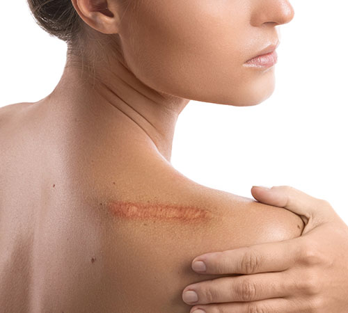 Permanent Tattoo Removal Near Me