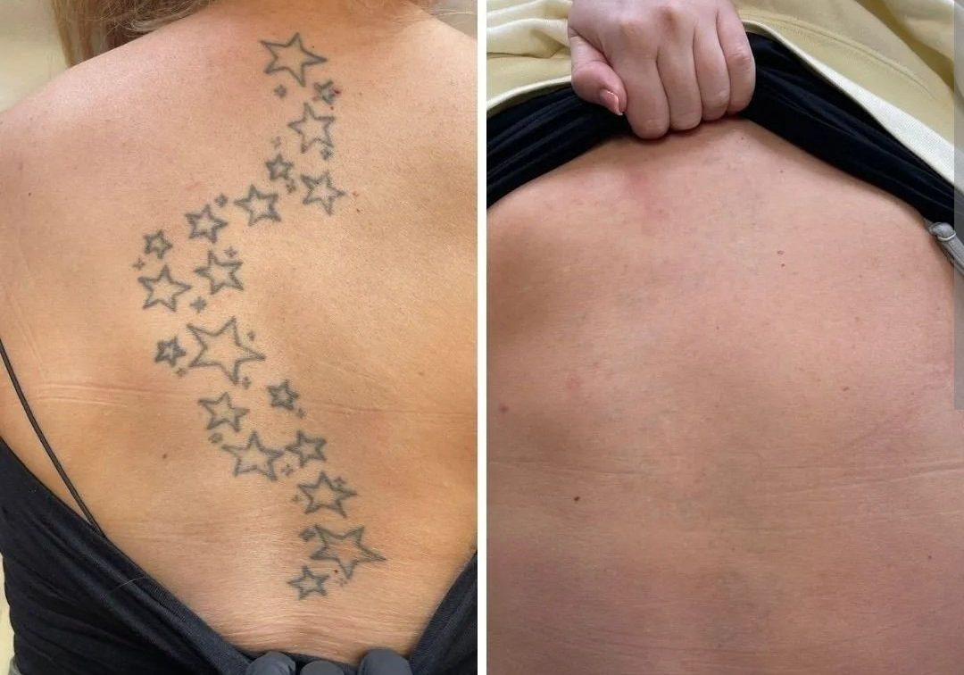 Tattoo Removal Near Me in Chennai