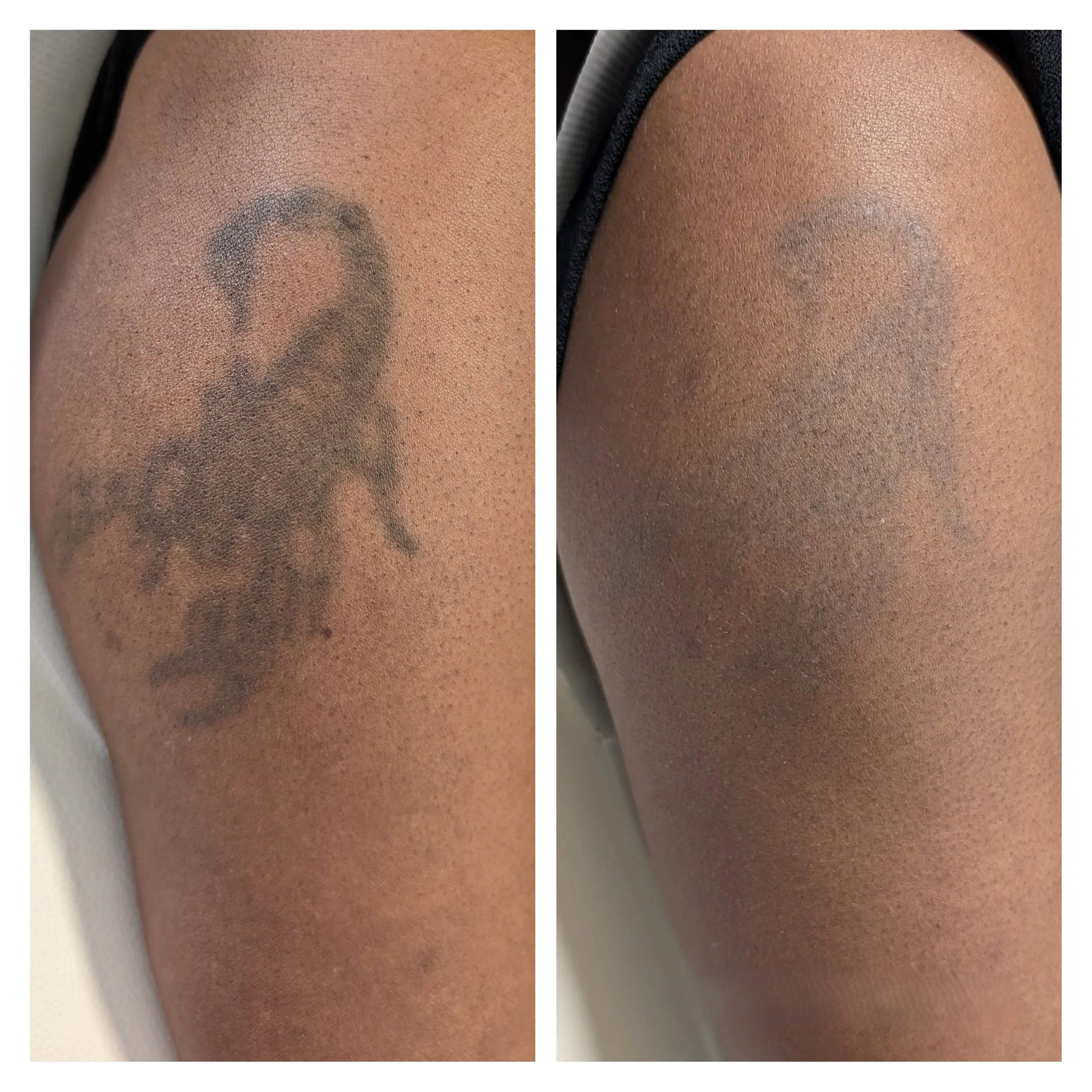 Best Laser tattoo removal near me