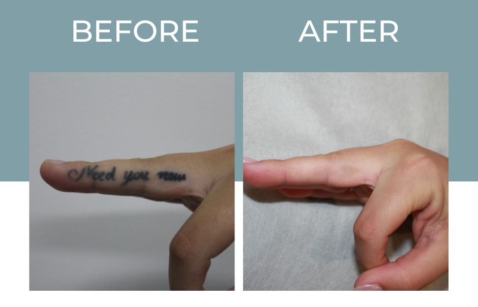 Tattoo removal cost