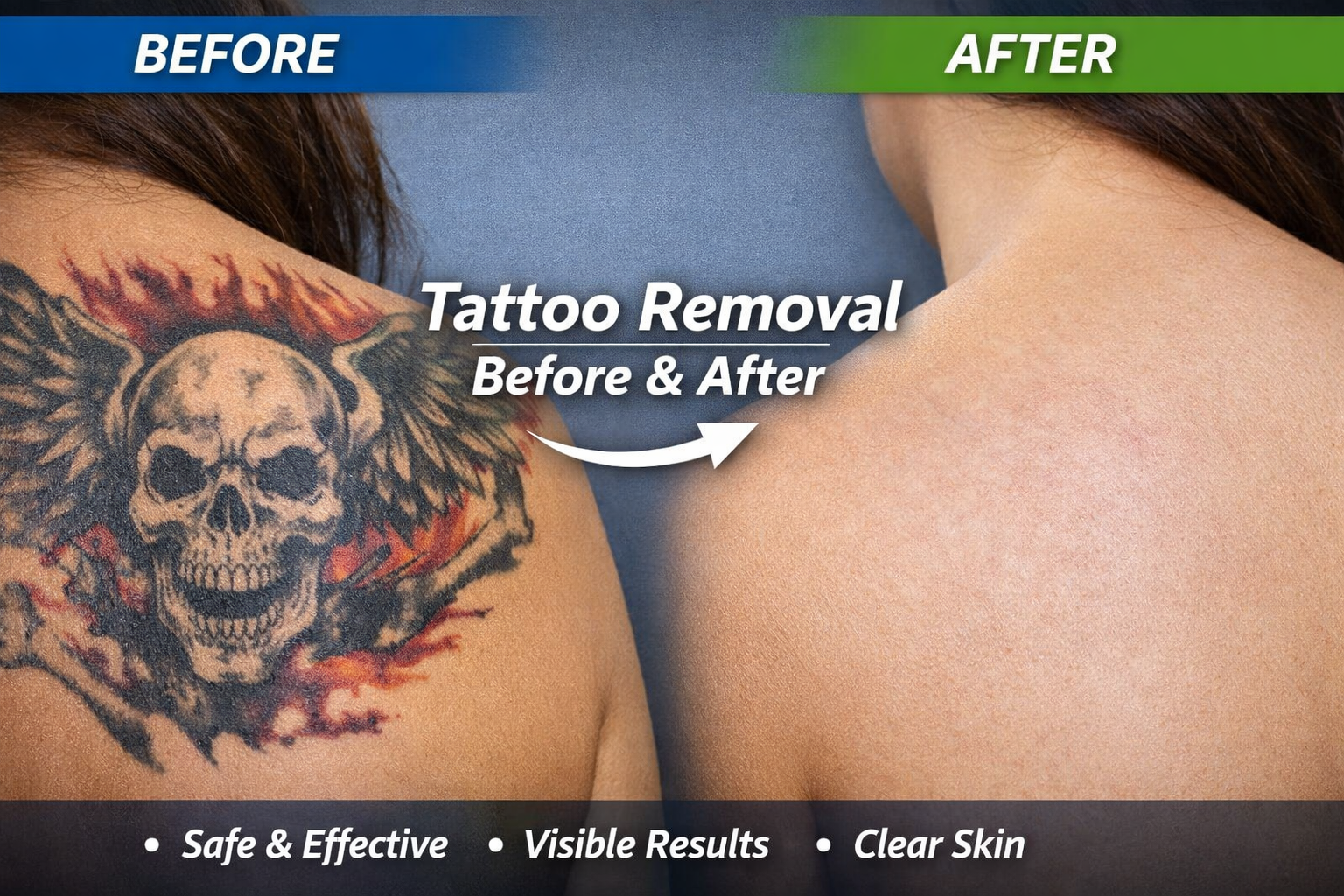 Best Tattoo Removal Before and After Treatment in Chennai