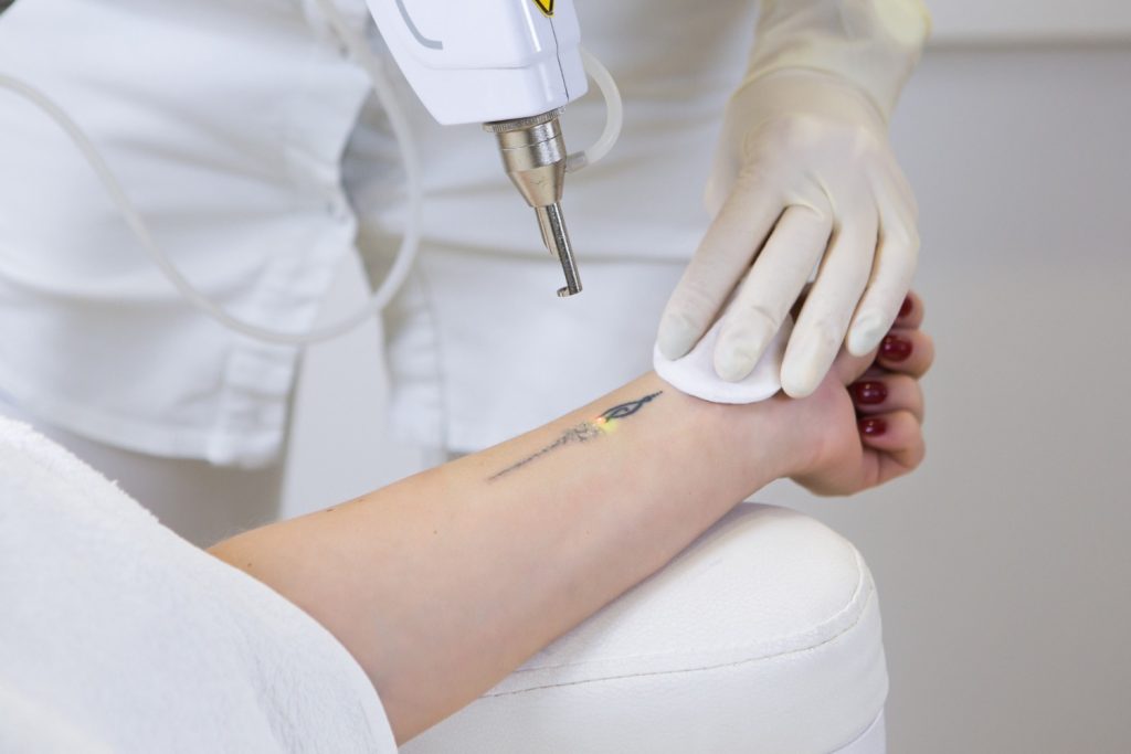Best Tattoo Removal Before and After Treatment in Chennai