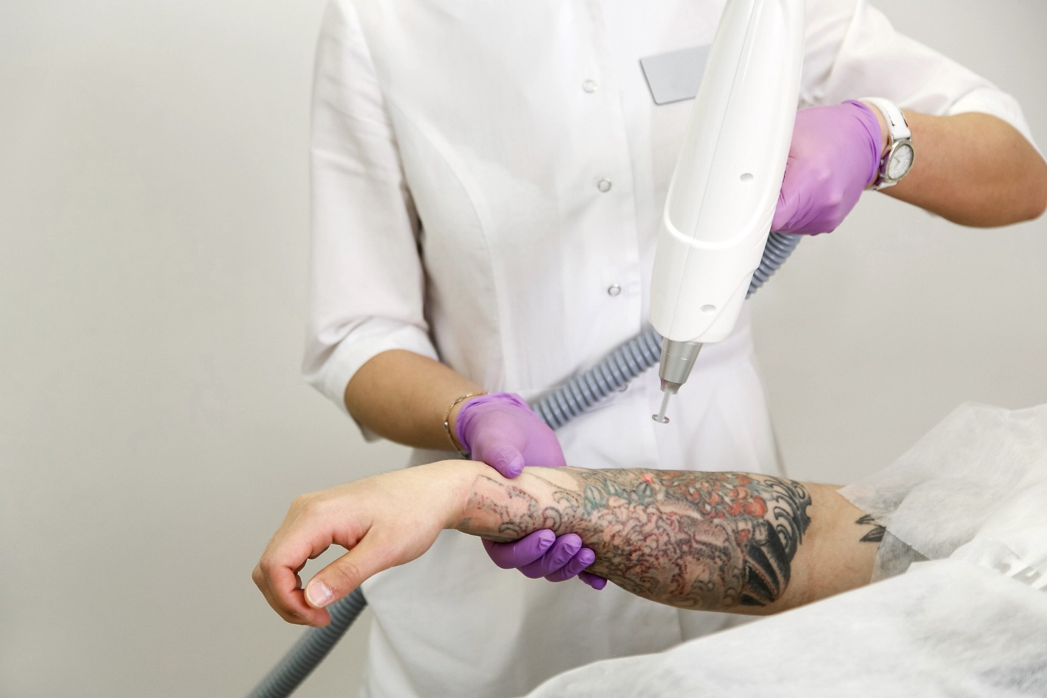 Best Tattoo Removal Before and After Treatment in Chennai