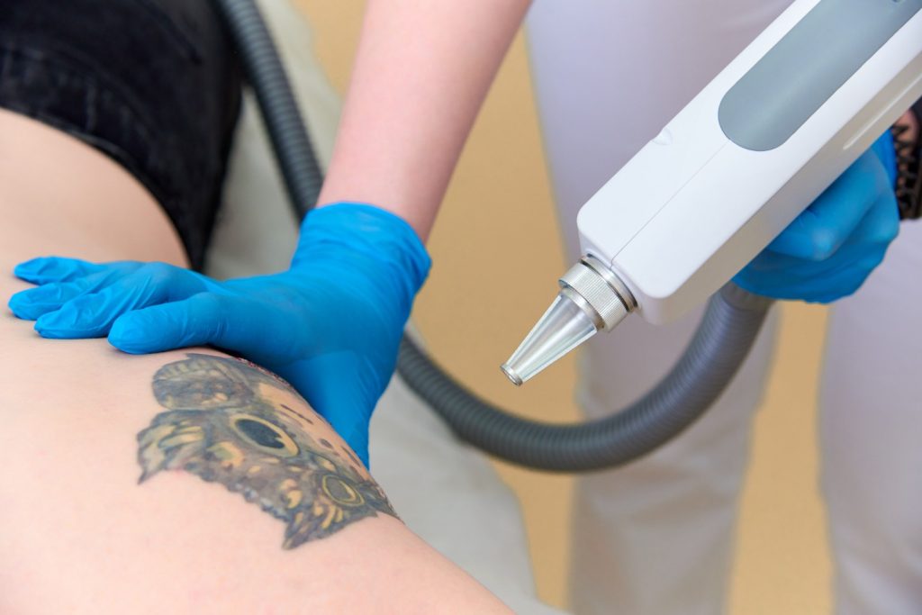 Advanced Laser Tattoo Removal in Nungambakkam, Chennai